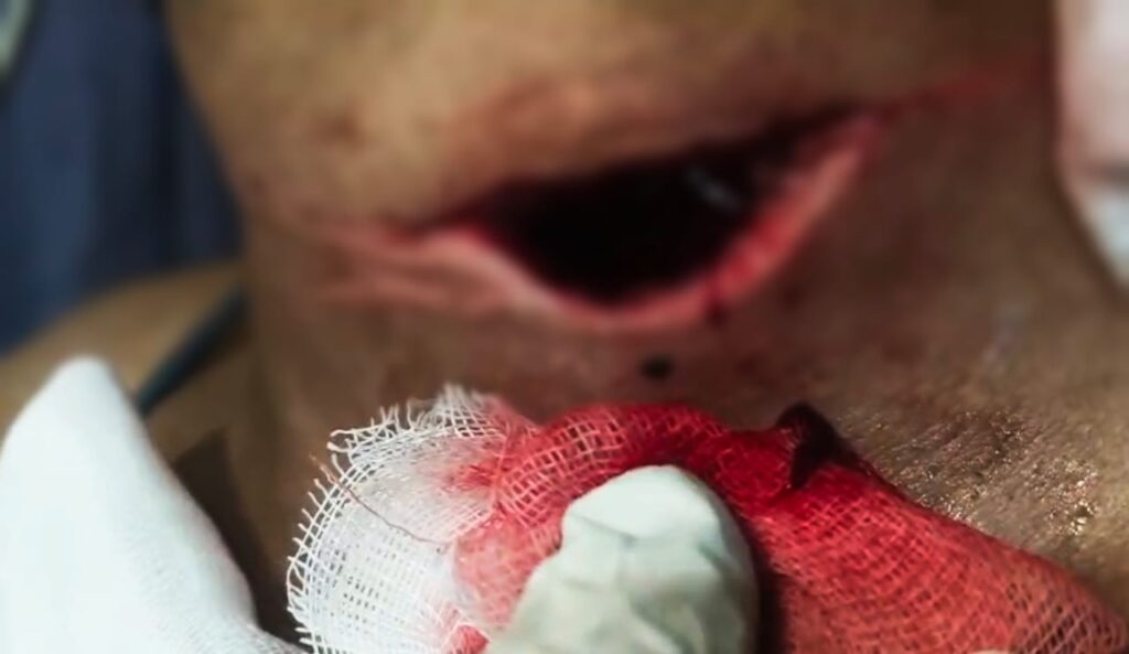 प्रतिबंधित चाइनीज मांझा एक बार फिर जानलेवा होने लगा साबित , मोतीचूर फ्लाईओवर पर बाइक सवार युवक चाइनीज मांझे की चपेट में आया,,,